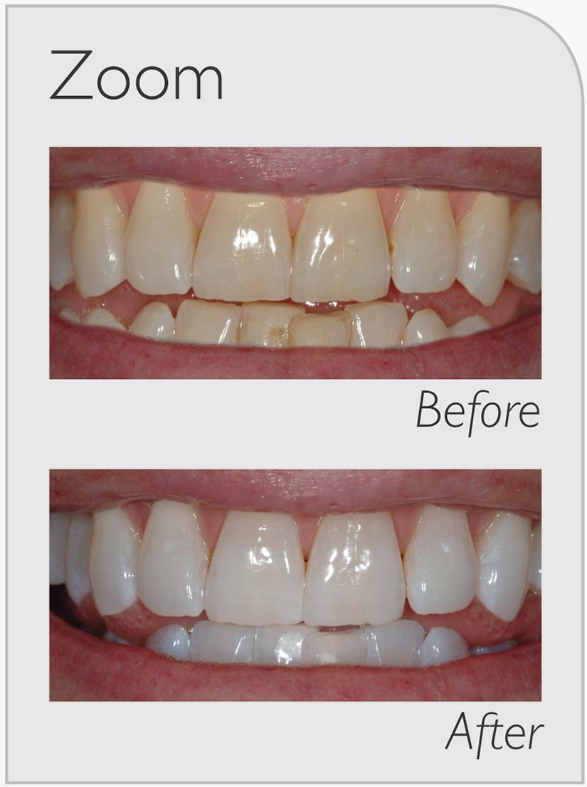 Zoom-Whitening-Before-&-After