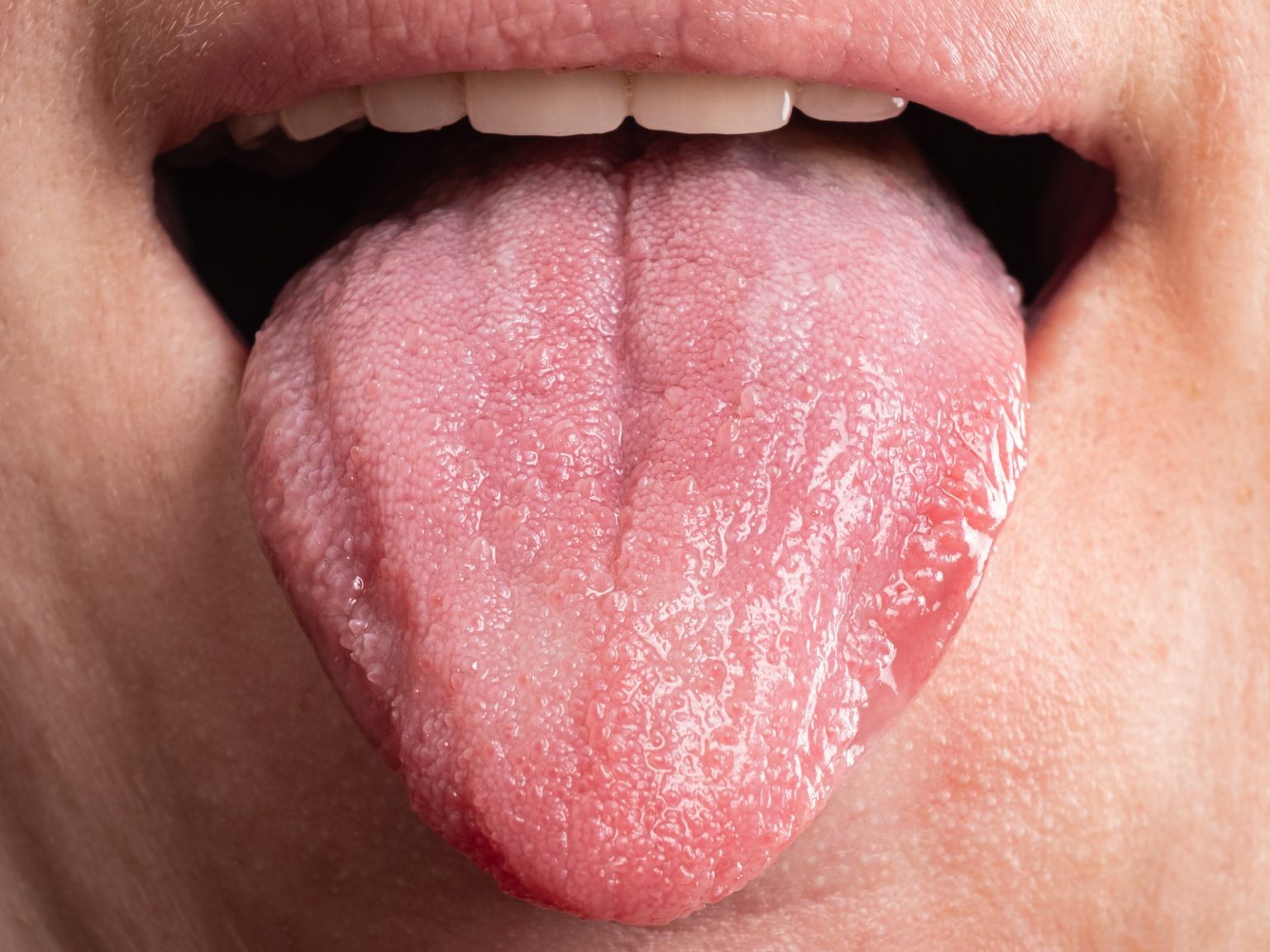 how-tongue-ties-affect-your-oral-health-and-its-solution