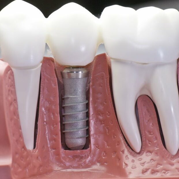 dental implants